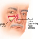 Polyps and Other Nasal Diseases