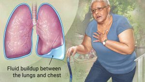PLEURA AND LUNGS DISEASES