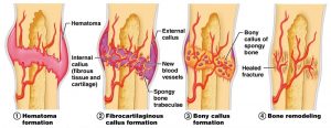 Bone Fracture 