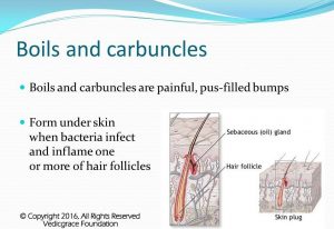 Tumors Boils Carbuncles Abscess