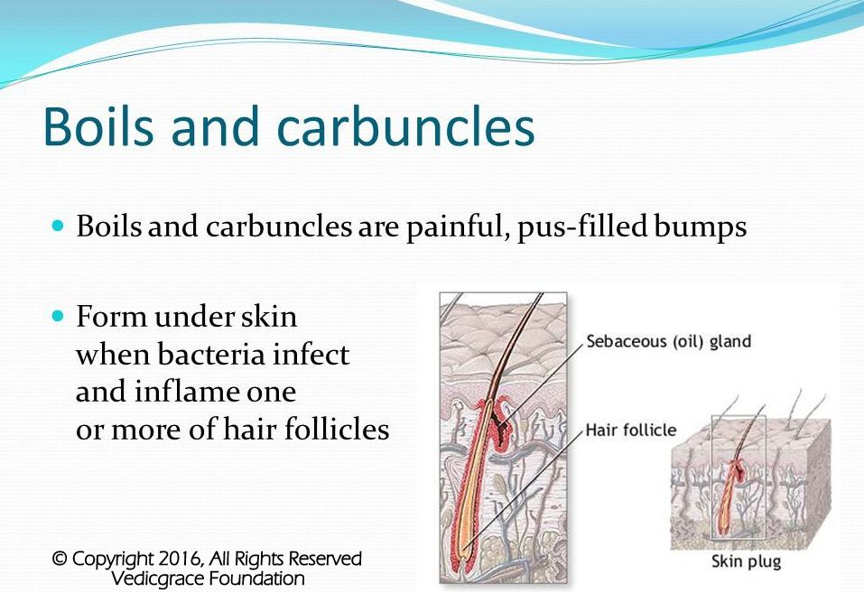 Carbuncle vs abscess