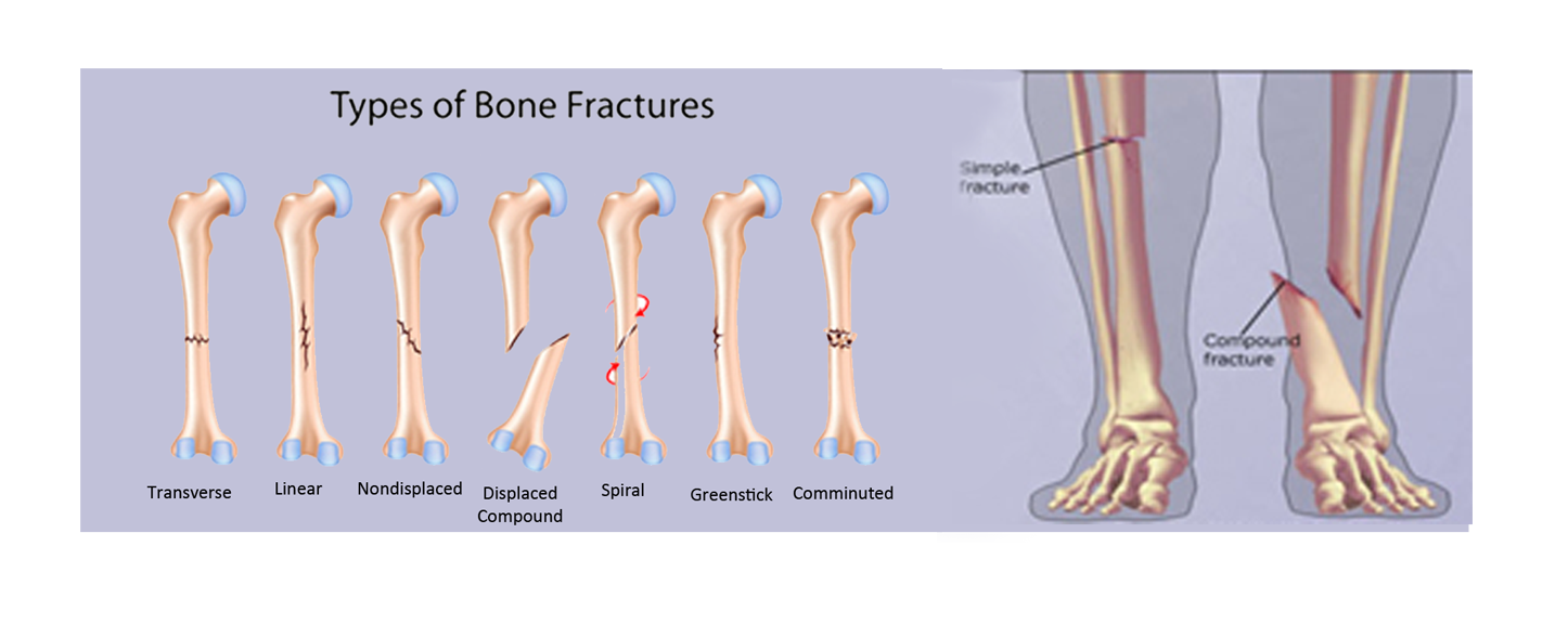 different types of bone fracture