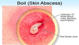 Tumors Boils Carbuncles Abscess 